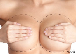 Breast Augmentation - Implants