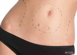 Liposuction