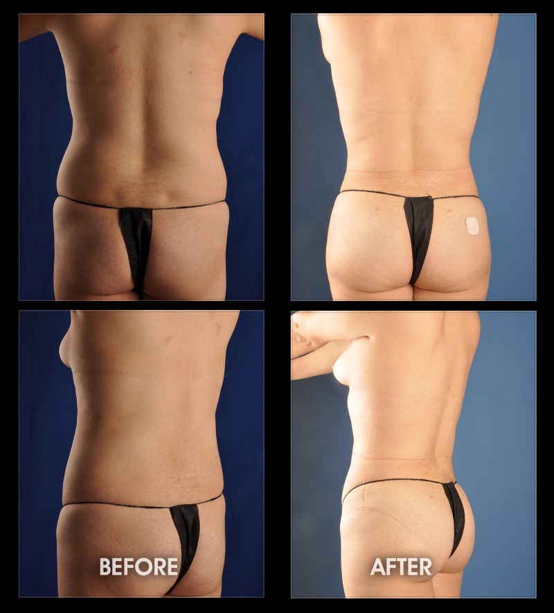 Hip Dip Fat Transfer - Reforme Medical